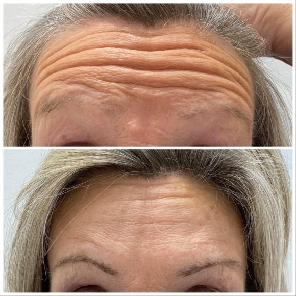 brow lifting at Pixel Perfect beauty clinics in London's Harley Street