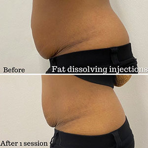Aqualyx® Fat Dissolving Injections at Pixel Perfect Clinics in Harley Street, London & Southampton
