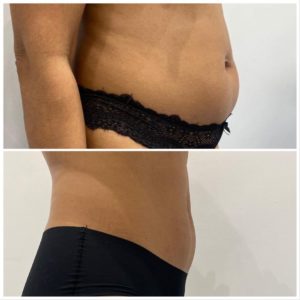 Aqualyx® Fat Dissolving Injections at Pixel Perfect Clinics in Harley Street, London & Southampton