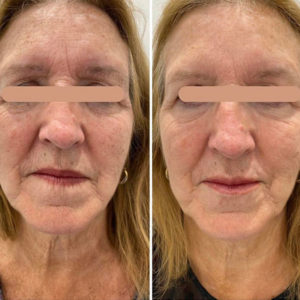 Tear Trough Treatment Specialist, Harley Street London & Southampton at Pixel Perfect Aesthetics Clinics