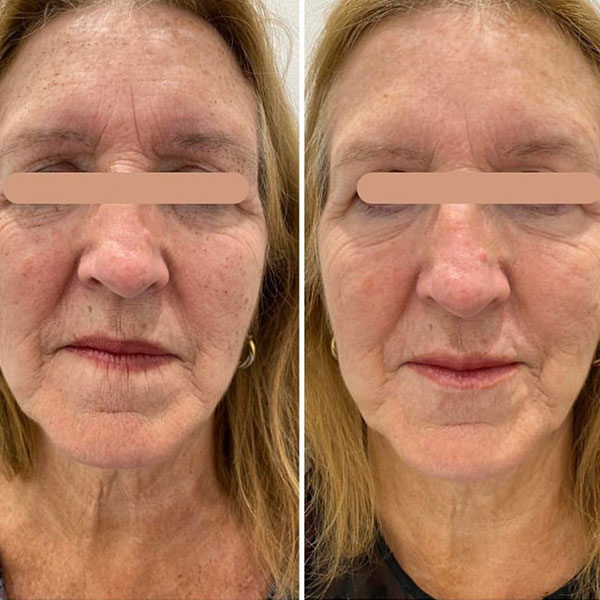 Effective Tear Trough Treatments