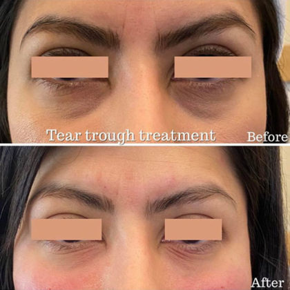 Tear Trough Treatment Specialist, Harley Street London & Southampton at Azra Aesthetics Clinics Tear Trough Treatment Specialist, Harley Street London & Southampton at Azra Aesthetics Clinics