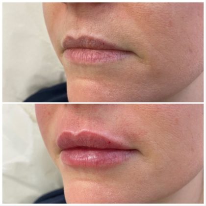 Lip Filler Specialist, Harley Street London & Southampton at Azra Aesthetics Clinics Lip Filler Specialist, Harley Street London & Southampton at Azra Aesthetics Clinics
