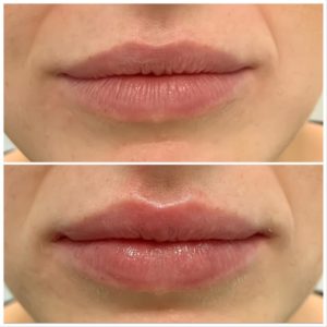 Anti-Wrinkle Treatments at Top Clinics in Marylebone, Central London & Southampton
