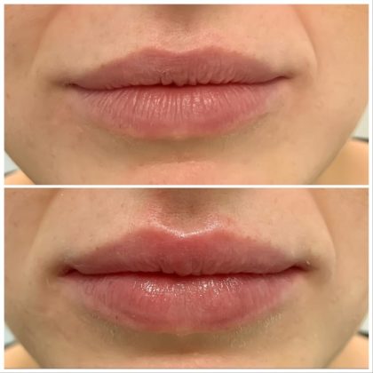 Anti-Wrinkle Treatments at Top Clinics in Marylebone, Central London & Southampton Anti-Wrinkle Treatments at Top Clinics in Marylebone, Central London & Southampton