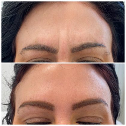 Tear Trough Treatment Specialist, Harley Street London & Southampton at Azra Aesthetics Clinics Tear Trough Treatment Specialist, Harley Street London & Southampton at Azra Aesthetics Clinics