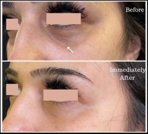 Dermal fillers at Azra Aethetics