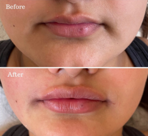 Lip Filler Specialist, Harley Street London & Southampton at Azra Aesthetics Clinics