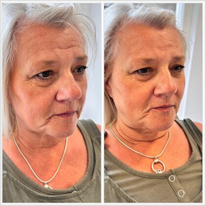 forehead fillers near me forehead fillers near me