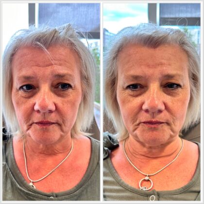 temple fillers southampton aesthetic clinics temple fillers southampton aesthetic clinics