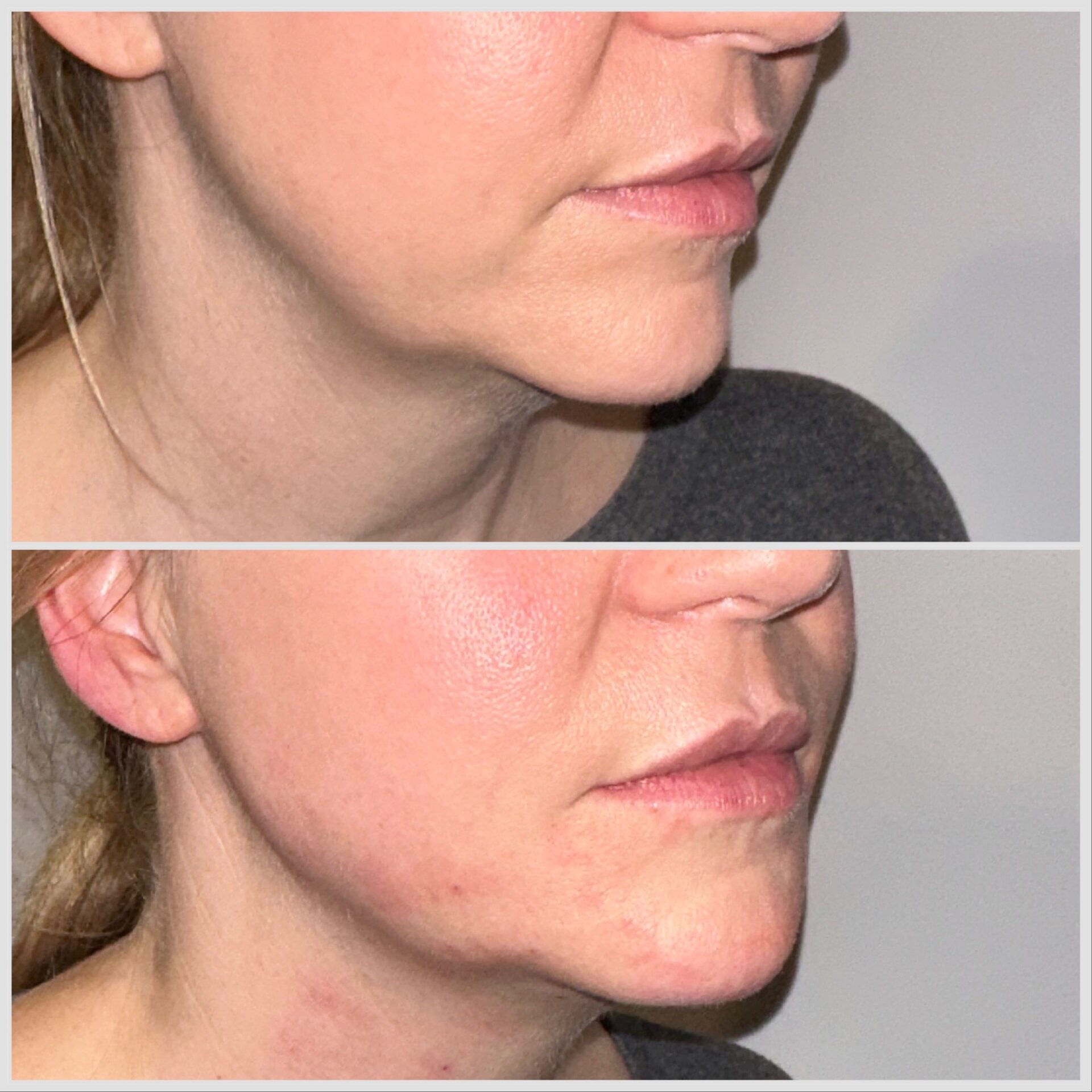 Semi Permanent Dermal Fillers Dr Asalet in Southampton & Harley Street, London Semi Permanent Dermal Fillers Dr Asalet in Southampton & Harley Street, London