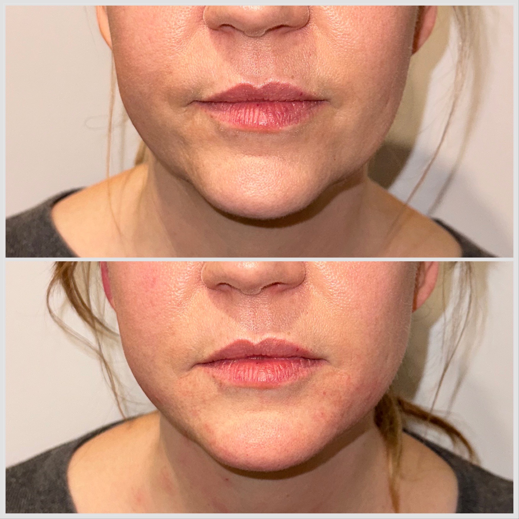 RADIESSE® Southampton & Harley Street, London RADIESSE® Southampton & Harley Street, London