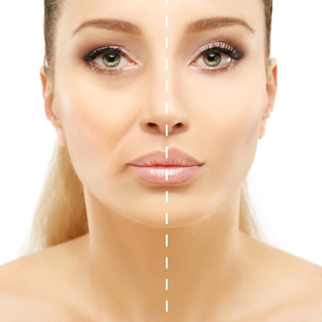 Nasolabial Folds Treatments at Azra Aesthetics in Harley Street, London & Southampton.