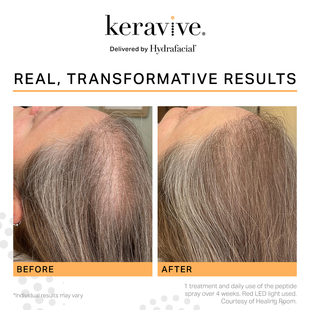 Hydrafacial Keravive Treatments at Pixel Perfect Aesthetic Clinic in Southampton Hydrafacial Keravive Treatments at Pixel Perfect Aesthetic Clinic in Southampton