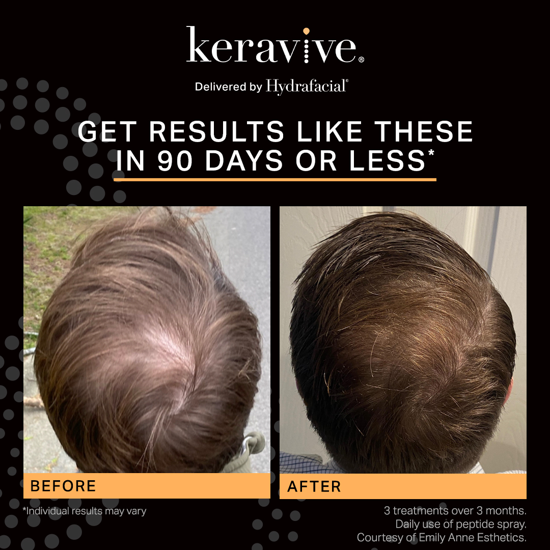 Hydrafacial Keravive Treatments Southampton Hydrafacial Keravive Treatments Southampton
